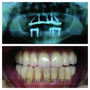 All-on-5 Dental Implant