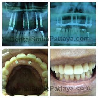All-on-6 Dental Implant